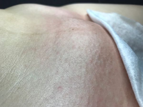 Депиляция глубокого бикини