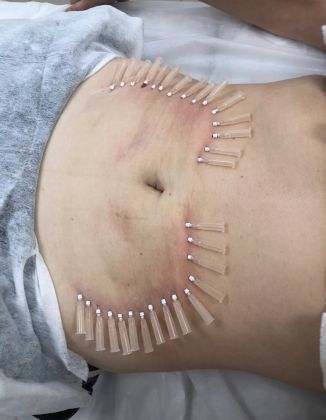 Подтяжка живота