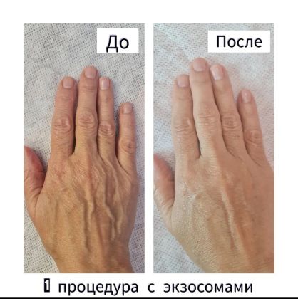 Мезофракционка с дермапеном - с 1 процедуры такой результат