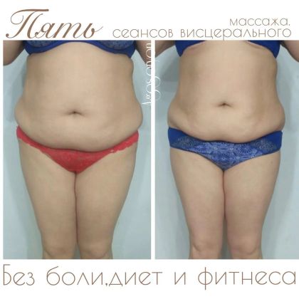 Комплексная работа по коррекции фигуры. Использовались висцеральные техники, лимфодренажные техники, антицеллюлитные техники.