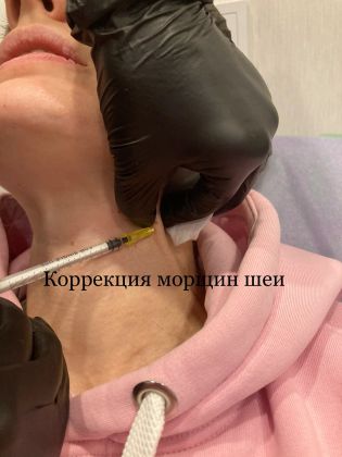 Коррекция морщин шеи 