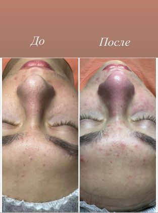 
ИНТЕНСИВНАЯ 12 ЭТАПНАЯ ЧИСТКА ЛИЦА 
1.Демакияж 
2.Глубокое очищение
3.Тонизирование 
4.Холодное гидрирование(раскрытие пор)
5.Ультразвуковая чистка 
6.Аквапилинг
7.Механическая чистка
8.Пилинг кислотный (всесезонный)
9.Фарфоровая куколка ?
10.Альгинатная маска
11.Дарсонвализация
12.Восстанавливающий крем 
