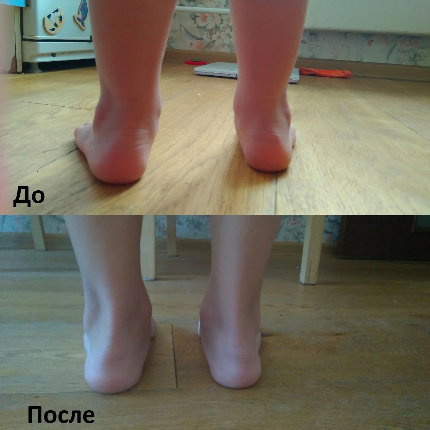 Вальгус У Детей 2 Года Фото