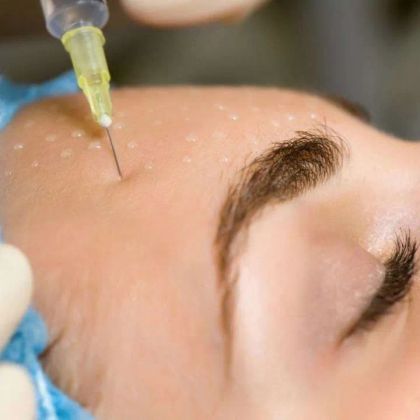 Мезотерапия лица антиакне