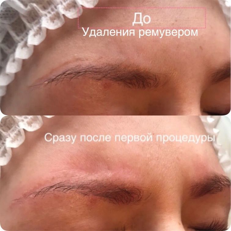Удаление татуажа глаз, губ и бровей ремувером в Москве - Цена