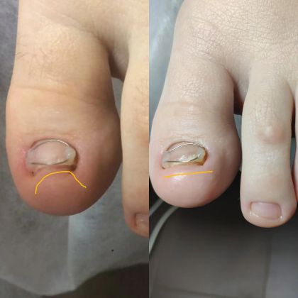 Результат спустя 1,5 месяца вытягивание ногтя титановой нитью