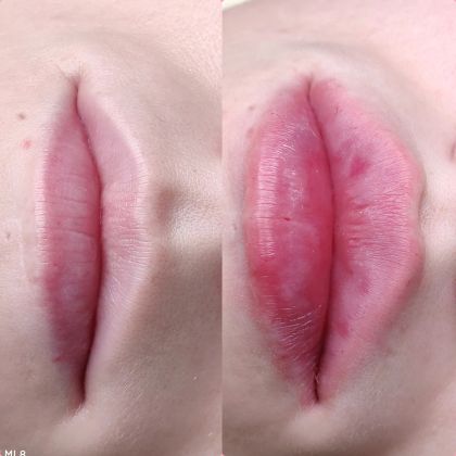 Увеличение губ. До и после