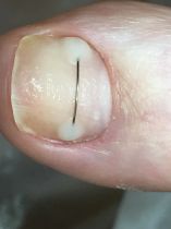 Корректирующая система, титановая нить снимает воспаление валиков, устраняет деформации ногтевой пластины
