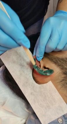 Удаление нежелательных волос 