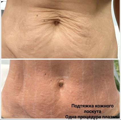 Процедура подтяжки кожного лоскута на животе.
1 процедура холодной плазмы