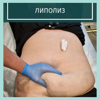 Липолитическая мезотерапия