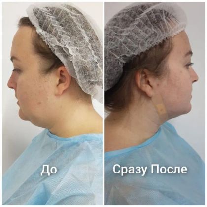 Липоредукция второго подбородка 