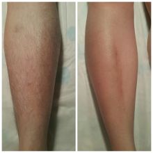 Ноги до и после процедуры шугаринга