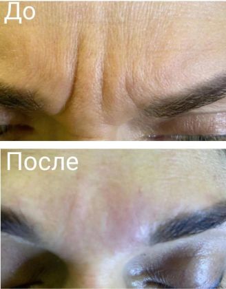 Заполнение межбровной складки филером,сразу после процедуры!