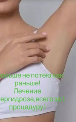 Лечение избыточной потливости.