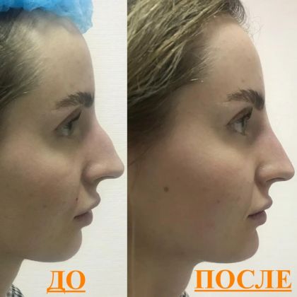 Устранение горбинки носа и выпрямление спинки, гармонизация профиля и формирование подбородочной зоны
