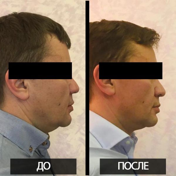 Smas-лифтинг средней и нижней трети лица (щеки и подбородок), результат спустя месяц после процедуры