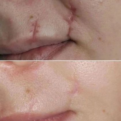 Работа аппаратом холодная плазма, рубцы, шрамы, растяжки, подтяжка кожного лоскута(от лица до ног), процедура проводится каждые 3-4 недели. Цена обсуждается индивидуально от размеров рубца, от 500р