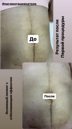 Отбеливание кожи от пигментации 