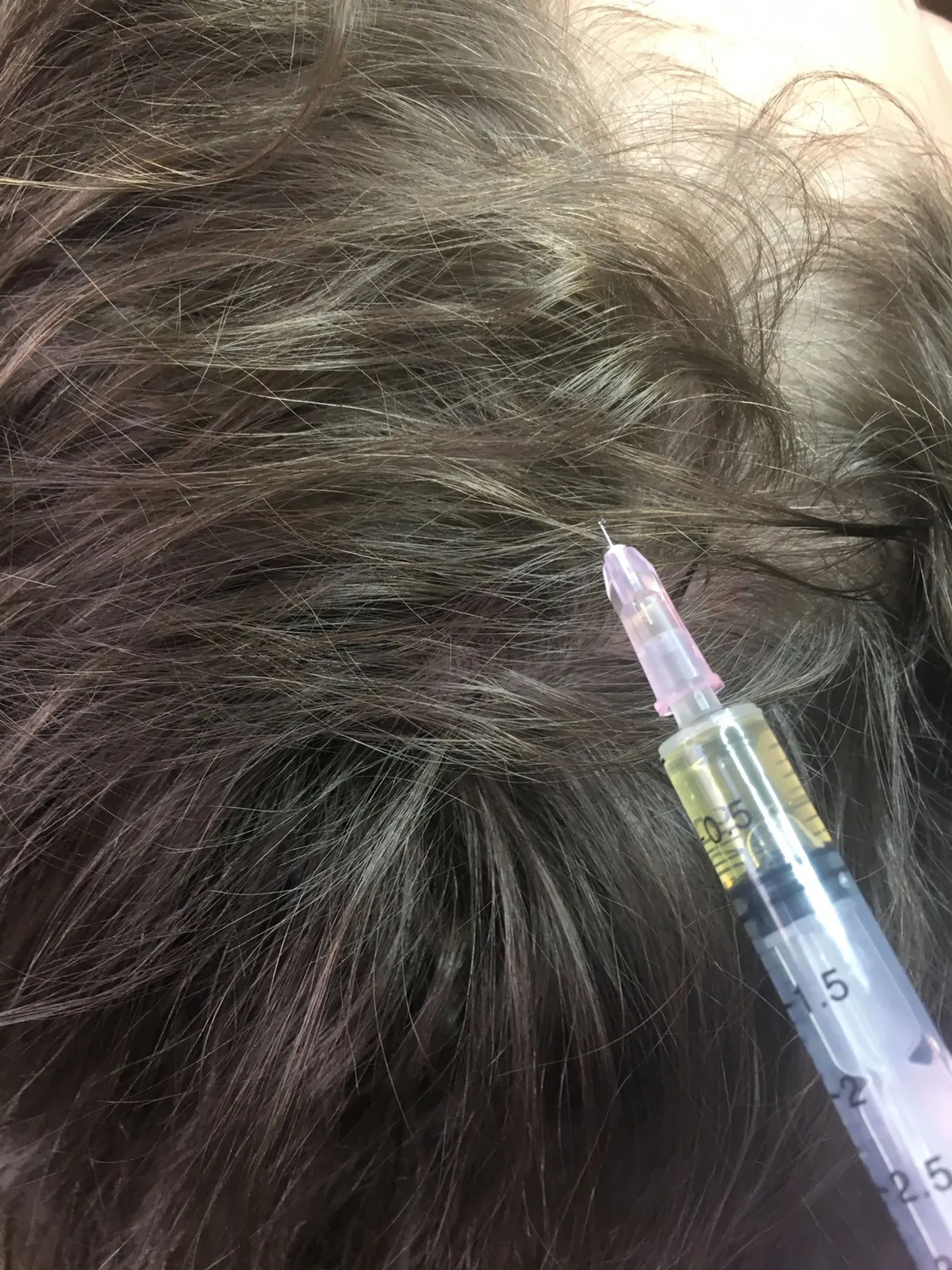 Мезотерапия для волос москва. Мезотерапия для волос. Фракционная мезотерапия для волос. Мезотерапия волос картинки. Мезотерапия для волос от выпадения.