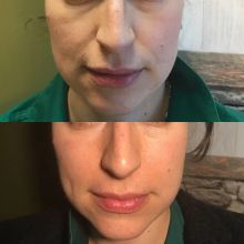 Массаж лица до и после 1 процедуры массажа