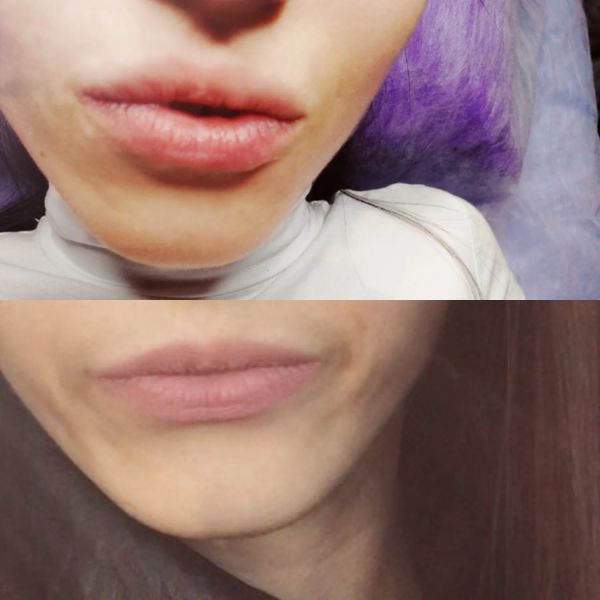 Увеличение губ 