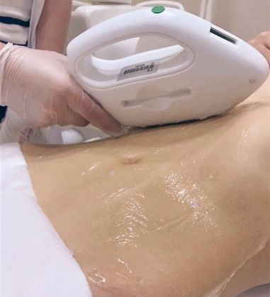 Лазерная диодная эпиляция живота полностью 