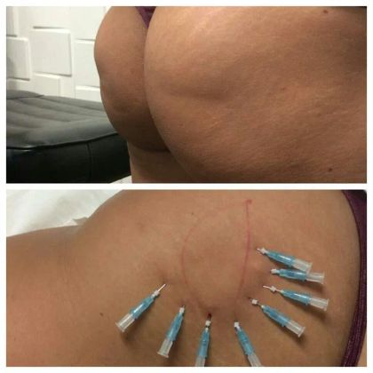 уплотнение кожимезонити на ягодицах