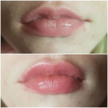 Коррекция ассиметрии губ,незначительное увеличение