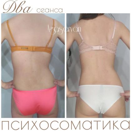 Сколиоз 2-3 степень,с ротацией позвонков. Пример работы с психосоматикой.Два сеанса с перерывом в месяц(клиентка приходит когда есть возможность)