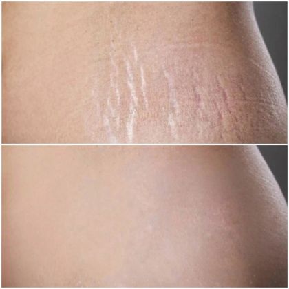 Камуфляж растяжек (стирий)
Я ппофессионально занимаюсь дермопигментацией, в том числе камуфлирую рубцы различного происхождения