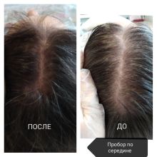 Мезотерапия волос результат после 5 процедуры 