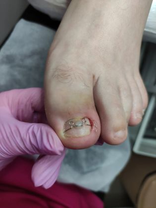 Установка скобы 3ТО