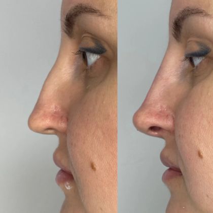 Тренд «Barbie nose»