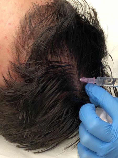 Мезотерапия волосистой части головы
