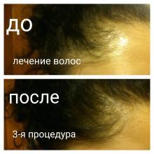 Мезотерапия волос, эффект после третьей процедуры