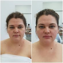 Данной клиентке 35 лет, на фото состояние тонуса кожи до и после первого проведенного первого сеанса массажа
