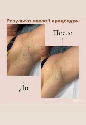 Эпиляция: удаление волос на коже.