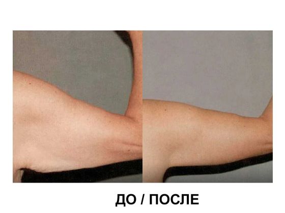 Отличный результат после микроигольчатого РФ лифтинга ; проведено две процедуры с промежутком в один месяц