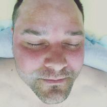 Шугаринг лица, проведена процедура по удалению нежелательных волос на зонах: брови, борода (скулы), нос, уши, окантовка, шея