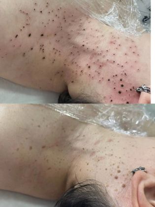 Удаление новообразования 