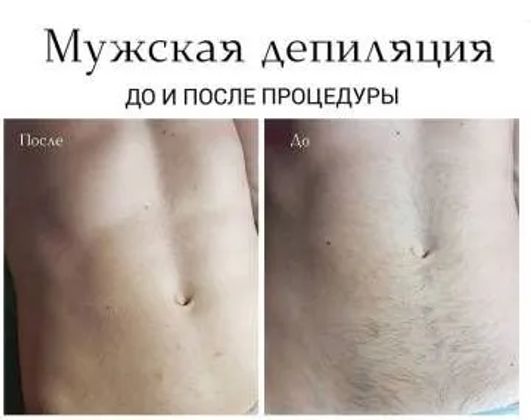 мужская депиляция