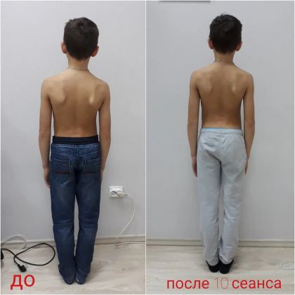 Исправление сколиоза у детей