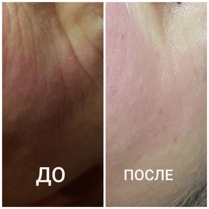 Результат курса процедур микротокового лимфодренажа – это расслабляющая процедура для тех, кто боится уколов и фракционной мезотерапии