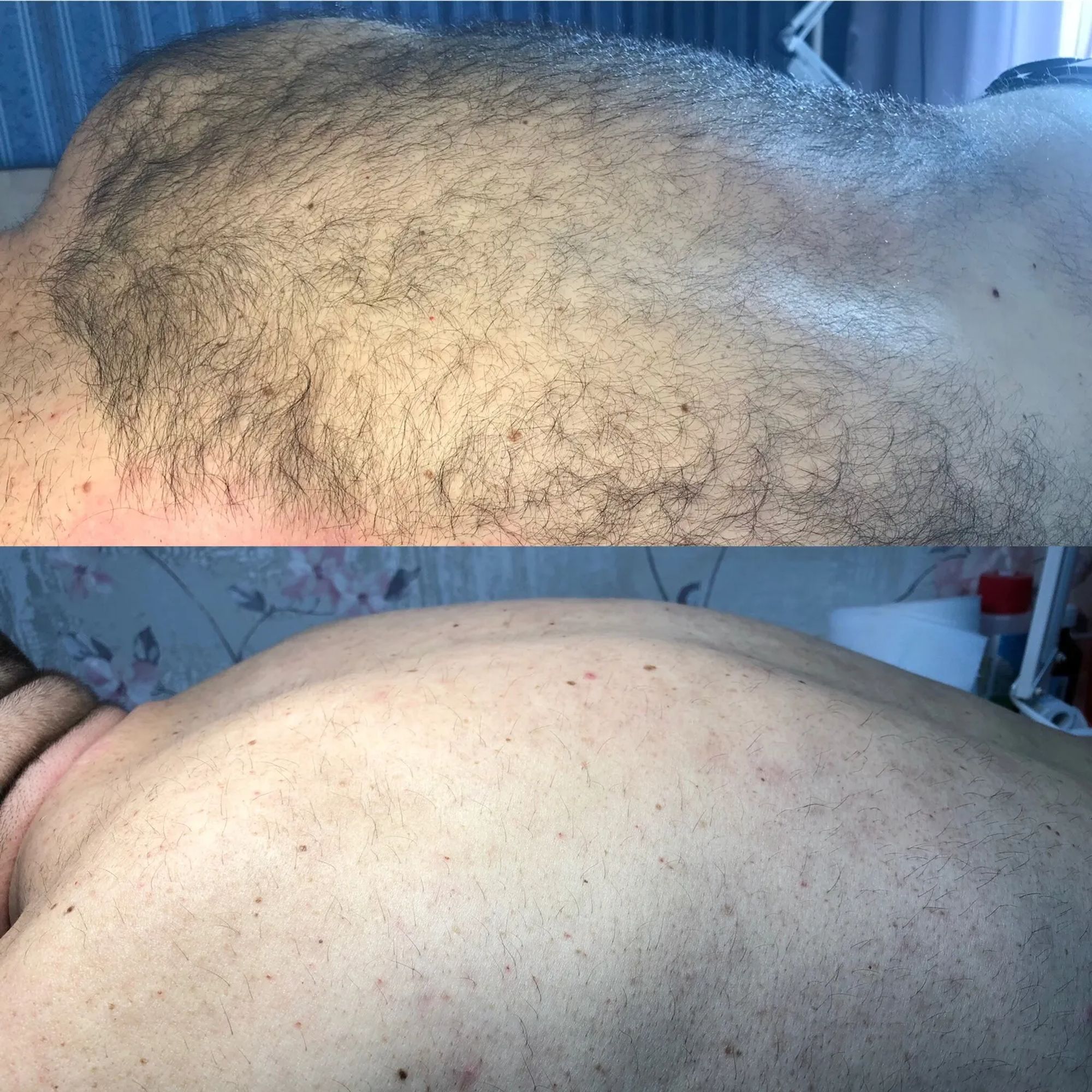 удаления волос на груди у мужчин навсегда фото 38