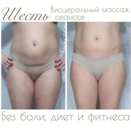 Комплексная работа по коррекции формы живота. Использовались висцеральные техники, антицелюллитные техники, скульптурные техники