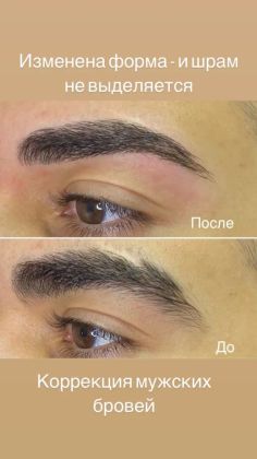 Скорректирована форма - задача минимизировать шрам. Что и сделано.